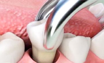 Hempstead Dental Tooth Extractions service