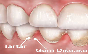Hempstead Dental Periodontal (Gum) Disease service