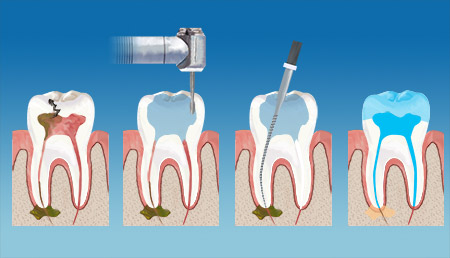 Hempstead Dental Endodontics Therapy service